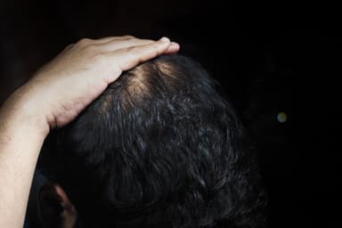 Démystifier la science | Le mystère de la calvitie masculine