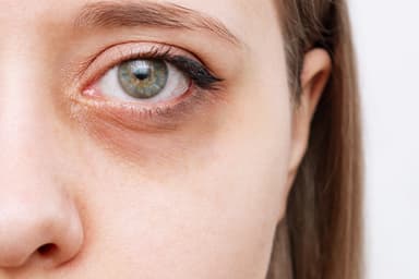Démystifier la science | Pourquoi a-t-on des cernes ?